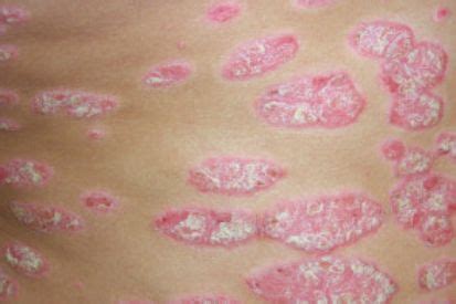 Psoriasis Symptoms And Treatment Keystone Dermatology Philadelphia Pa