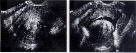 Submucosal Leiomyoma In 49 Year Old Woman A Sagittal Sonogram Of Download Scientific Diagram