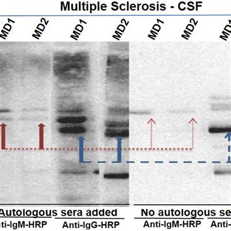 Presence Of Oligoclonal Bands In Csf Samples From Ms Patients Csf