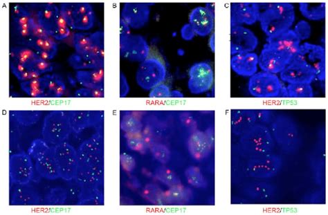 Co Amplification Of Her And Cep Without Polysomy Confirmed Using