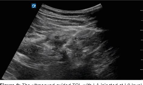 Ultrasound Guided Continuous Transmuscular Quadratus Lumborum Block L4