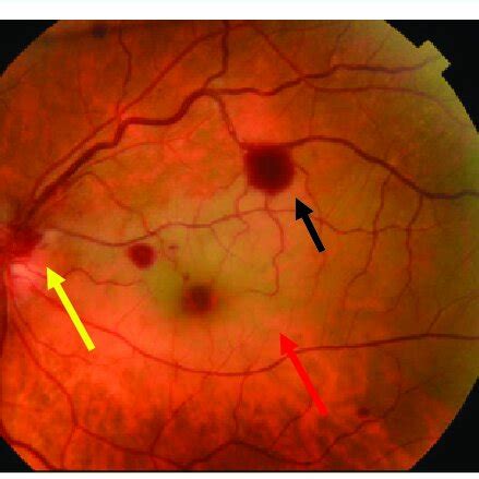 Fundus Photography Of The Left Eye Showed A Retinal White Edema In The