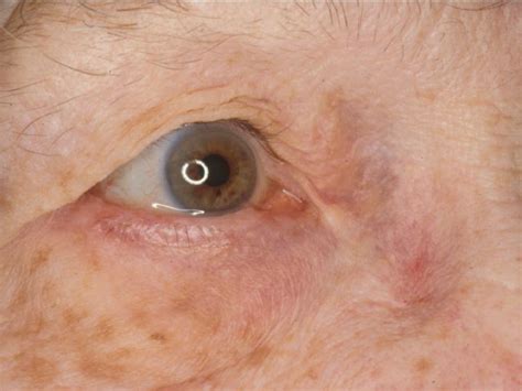 Khan Eyelid & Facial Plastic Surgery - Entropion