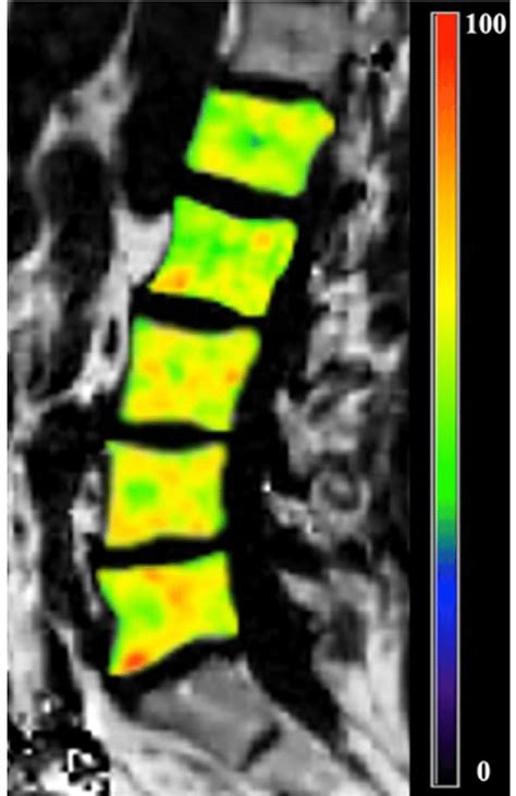 Proton Density Fat Fraction Pdff Map Obtained From The Six Echo D