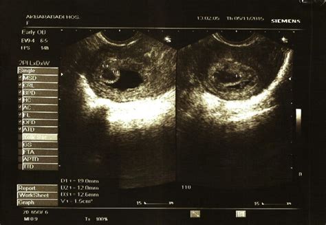 Transvaginal image of a chorionic bump; age of gestation: 5 weeks, 4 ...