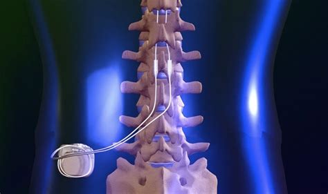 Frequently Asked Questions About Spinal Cord Stimulators For Low Back