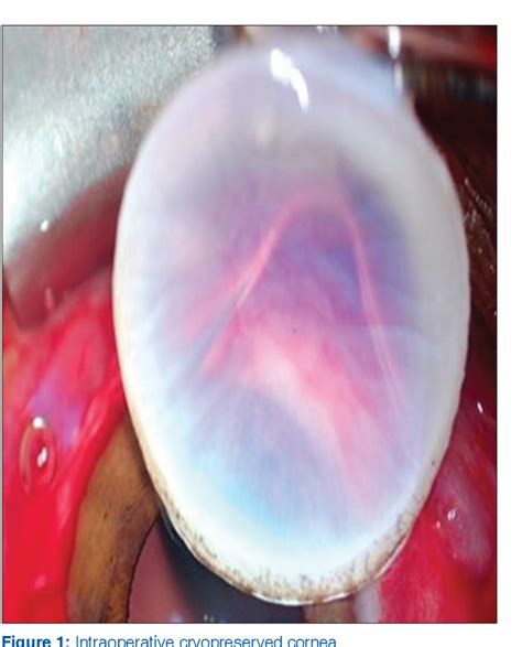 Figure 1 From Use Of Cryopreserved Donor Corneal Tissues First Time In