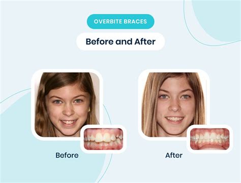 Fix Overbite Without Braces Explore Alternatives