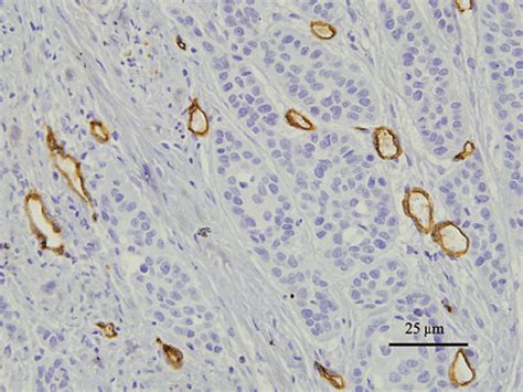 microvessel density MVD CD34 stained 5 µm sections of esophageal