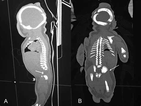 Sirenomelia Mermaid Syndrome A Rare Congenital Disorder Bmj Case