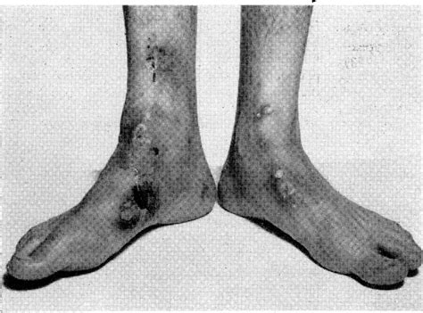 Figure I From Calcinosis Cutis Old Dermatomyositis Semantic Scholar