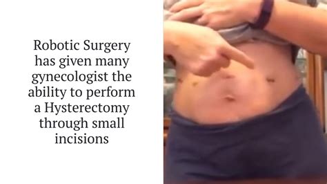 Robotic Hysterectomy Vs Micro Laparoscopic Hysterectomy Youtube