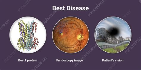 Best vitelliform macular dystrophy, illustration - Stock Image - F037 ...