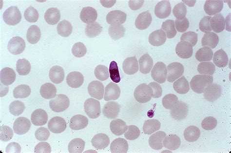 Imagen Gratis Microfotografía Muestra De Sangre El Plasmodium Falciparum Anillos Eritrocitos