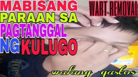 Paano Magtanggal Ng Kulugo Wart Ng Walang Gastos Youtube