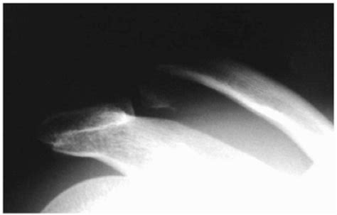 Acute Fractures Malunions And Nonunions Of The Clavicle