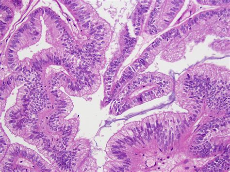 Pathology Outlines Endometrioid Carcinoma | Free Download Nude Photo ...