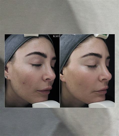 Reviewed Cosmelan Md Peel For Melasma Who What Wear