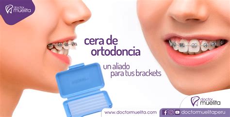 La Cera De Ortodoncia Un Gran Aliado Para Tus Brackets Doctor Muelita