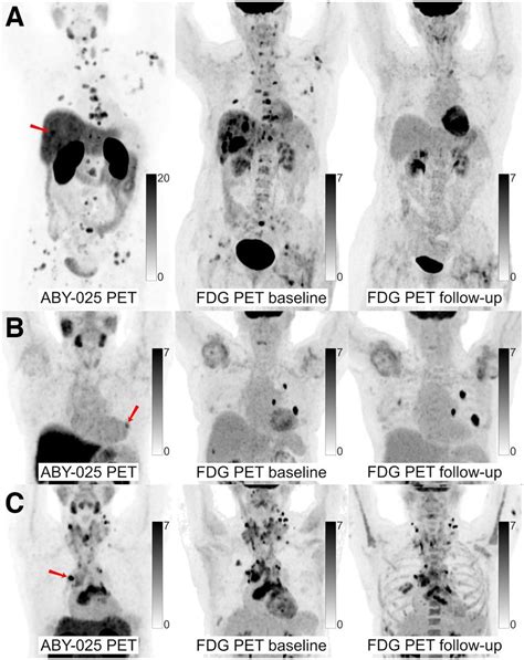 Whole Body Pet Ct Predicts Response To Her Targeted Therapy In