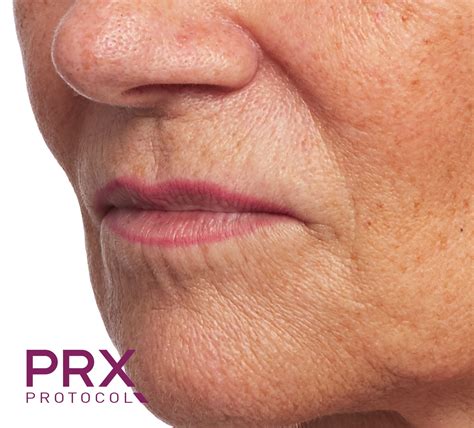 Prx Derm Perfexion Before And After Acqua Blu Medical Spa