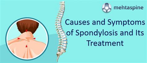 Spondylolysis Of The Lumbar Spine Symptoms Causes Treatments Images