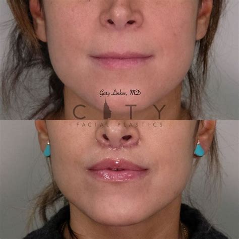 Lip Lift Before And After Photos