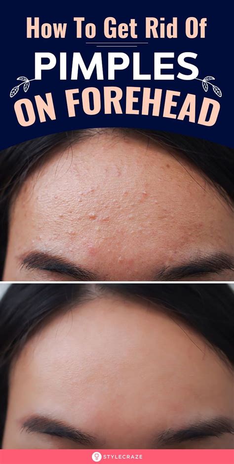 How To Get Rid Of Pimples On Forehead Pimples On Forehead Forehead