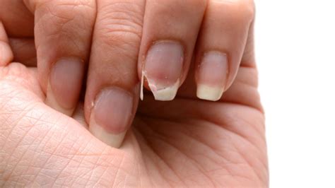 How To Treat Peeling Nails Causes Treatment And Prevention Cns News