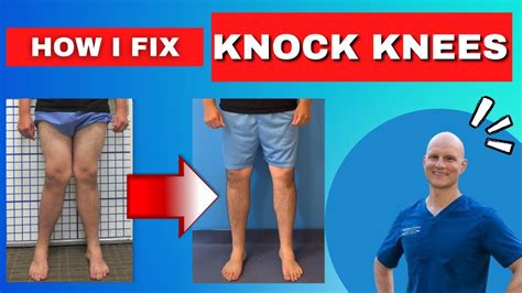 The Only Way To Fix Knock Knees Get The Facts Youtube