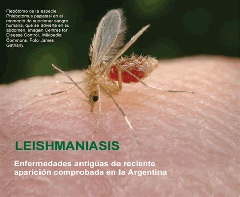 La Leishmaniasis 17040 The Best Porn Website