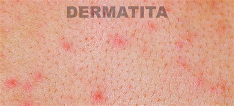 Dermatita De Contact