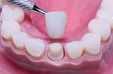 Capa De Porcelana Nos Dentes