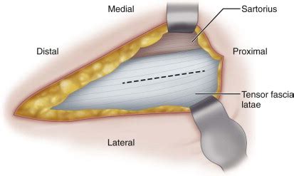 Direct Anterior Approach for Total Hip Arthroplasty | Musculoskeletal Key