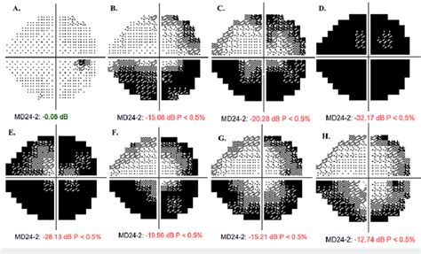 Right Eye Od Visual Field Progression Overview Visual Field Prior To