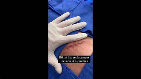 Direct Anterior Hip Replacement With Bikini Incision 1 Week Doing Great