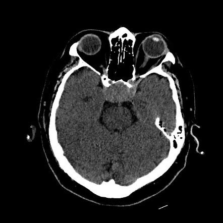 Adamantinomatous Craniopharyngioma Image Radiopaedia Org