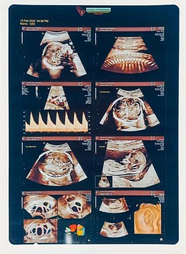 hd white inkjet pvc sheet   ray usg  sheet sonography