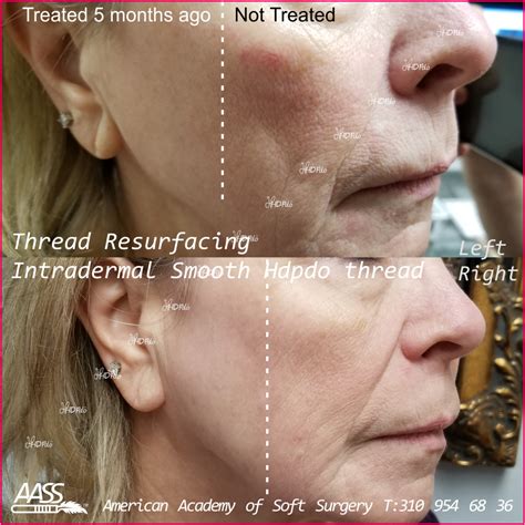 HDPDO Thread Lift - Inland Cosmetic Surgery