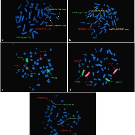 Metaphase Fish Of Patient No A And No B Showing Kat A Crebbp