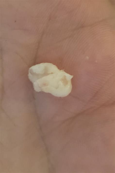 Cyst Sac Popped Out This Morning Rpopping