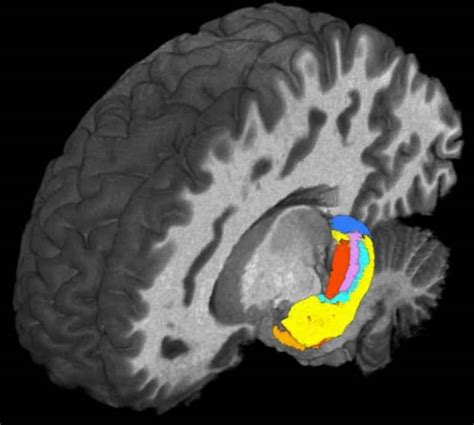 Ultra High Field Mri Detects Differences In Brains Hippocampus