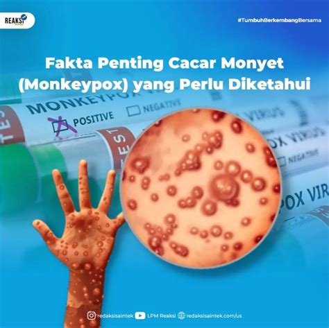 Fakta Penting Cacar Monyet Monkeypox Yang Perlu Diketahui Redaksi