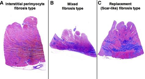 Histological And Histometric Characterization Of Myocardial Fibrosis In
