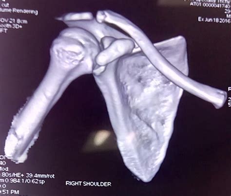 Right Scapula Fracture