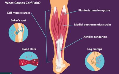 Calf Strain and Muscle Spasm of the Leg