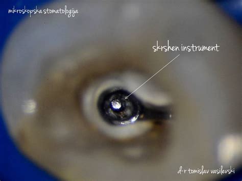 Removal Of Broken Instrument From Root Canal Under Microscope D R Tomislav Vasilevski