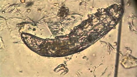 Demodex àcar de la pell Demodex ácaro de la piel YouTube