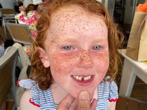 Taches De Rousseur Freckles Face James Thompson