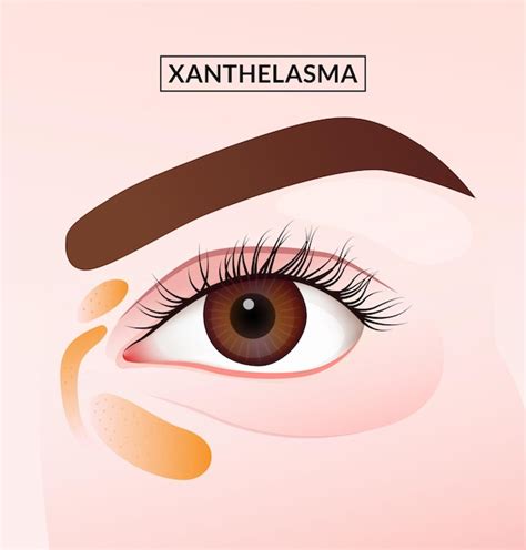 Premium Vector | Closeup of woman close up of eyelid with xanthelasma